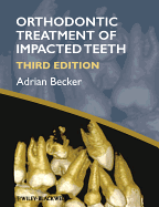 The Orthodontic Treatment of Impacted Teeth