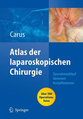 Atlas Laparoskopische Chirurgie - Carus, Thomas