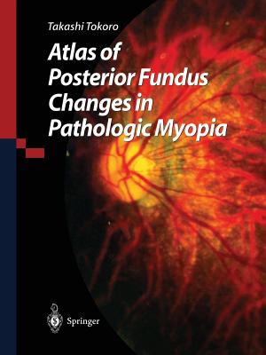 Atlas of Posterior Fundus Changes in Pathologic Myopia - Tokoro, Takashi