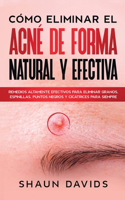 C?mo Eliminar el Acn? de Forma Natural y Efectiva: Remedios altamente efectivos para eliminar granos, espinillas, puntos negros y cicatrices para siempre - Davids, Shaun