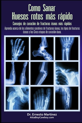 Como curar huesos rotos ms rpido. Consejos para curar fracturas de huesos: Aprenda sobre los alimentos para la curacin de fracturas, los tipos de fracturas y las cinco etapas de curacin. - Martinez, Ernesto, Dr.