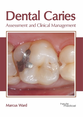 Dental Caries: Assessment and Clinical Management - Ward, Marcus (Editor)