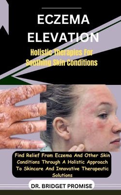 Eczema Elevation: Holistic Therapies For Soothing Skin Conditions: Find Relief From Eczema And Other Skin Conditions Through A Holistic Approach To Skincare And Innovative Therapeutic Solutions - Promise, Bridget, Dr.