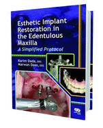 Esthetic Implant Restoration in the Edentulous Maxilla: A Simplified Protocol