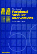 Fifty Cases of Peripheral Vascular Interventions