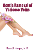 Gentle Removal of Varicose Veins
