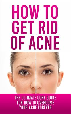 How to Get Rid of Acne: The Ultimate Cure Guide for How to Overcome Your Acne Forever - Lincoln, Caesar