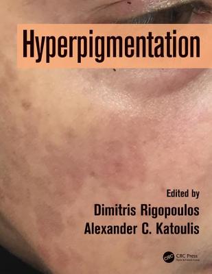 Hyperpigmentation - Rigopoulos, Dimitris (Editor), and Katoulis, Alexander C. (Editor)