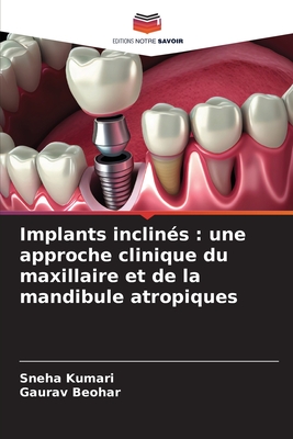 Implants inclin?s: une approche clinique du maxillaire et de la mandibule atropiques - Kumari, Sneha, and Beohar, Gaurav