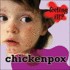 Chicken Pox