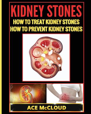 Kidney Stones: How To Treat Kidney Stones: How To Prevent Kidney Stones - McCloud, Ace