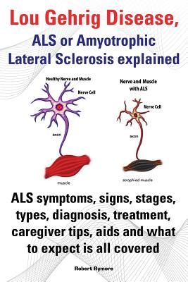 Lou Gehrig Disease, ALS or Amyotrophic Lateral Sclerosis Explained. ALS Symptoms, Signs, Stages, Types, Diagnosis, Treatment, Caregiver Tips, AIDS and - Rymore, Robert