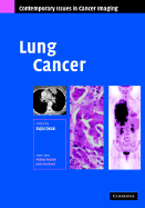 Lung Cancer