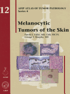 Melanocytic tumors of the skin