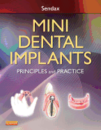 Mini Dental Implants: Principles and Practice