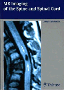 MR Imaging of the Spine and Spinal Cord
