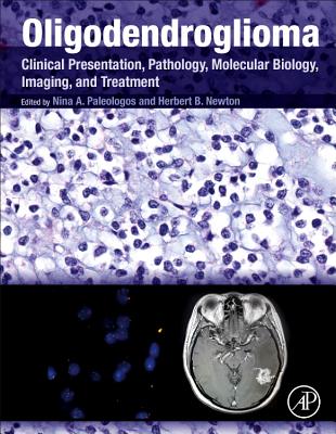 Oligodendroglioma: Clinical Presentation, Pathology, Molecular Biology, Imaging, and Treatment - Paleologos, Nina A (Editor), and Newton, Herbert B (Editor)