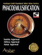 Phacoemulsification