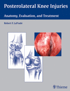 Posterolateral Knee Injuries: Anatomy, Evaluation, and Treatment
