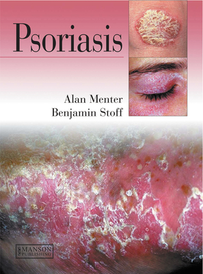 Psoriasis - Menter, Alan, and Stoff, Benjamin