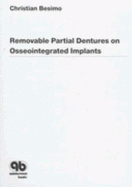 Removable Partial Dentures on Osseointegtated Implants: Principles of Treatment Planning and Prosthetic Rehab in the Edentulous Mandible