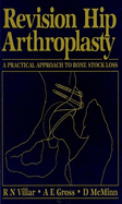 Revision Hip Arthroplasty: A Practical Approach to Bone Stock Loss