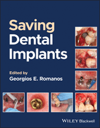 Saving Dental Implants