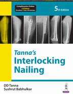 Tanna's Interlocking Nailing