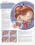 Understanding Liver Cancer Anatomical Chart - Acc, and Anatomical Chart Company (Prepared for publication by)