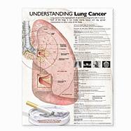 Understanding Lung Cancer Anatomical Chart