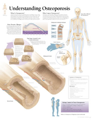 Understanding Osteoporosis - Scientific Publishing