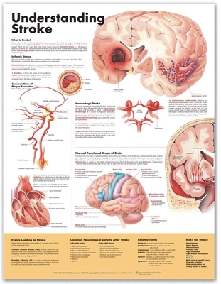 Understanding Stroke Anatomical Chart - Anatomical Chart Company (Prepared for publication by)